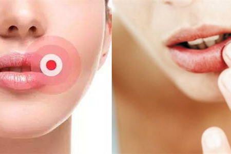 【图】嘴角长疱疹图片教你如何巧妙应对(图2)